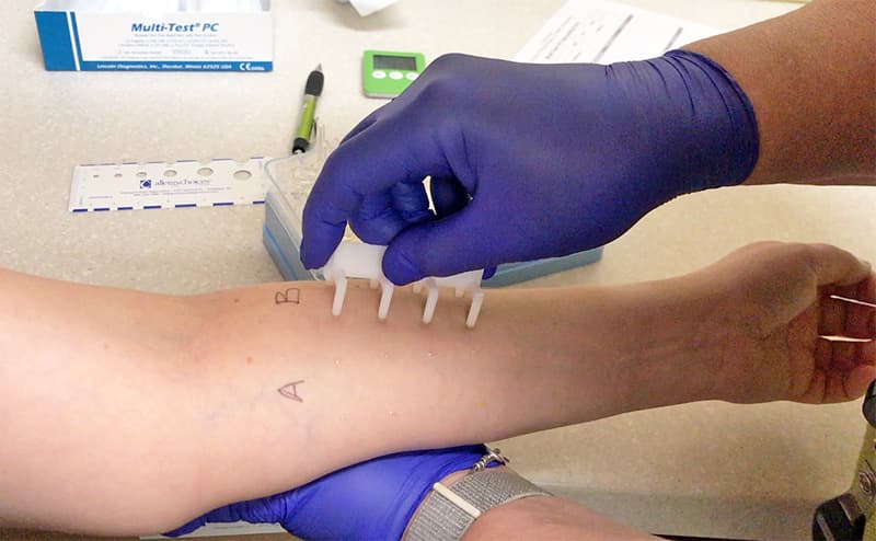 A gloved provider presses a multi-test skin prick applicator onto a patient's marked forearm.