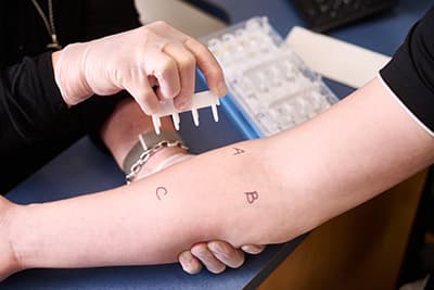 Allergy skin prick testing applied to a patient’s forearm in a clinic.