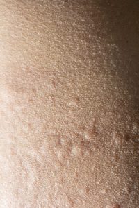 Allergic to the cold? Cold urticaria may be to blame.