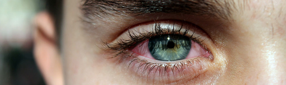 The biggest difference between pink eye and allergy is the pus and mucus that can gather in the eye. 